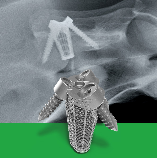 Cervical arthrodesis C6-C7 for adult horses